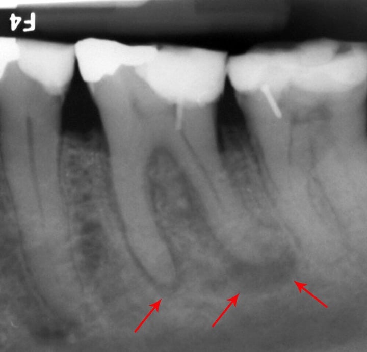 Abscessed Tooth