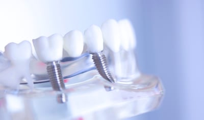 Why Dental Care Access Is a Global Health Crisis Most People Ignore