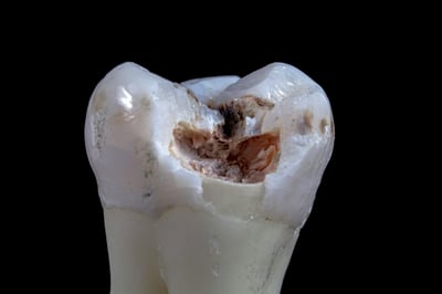 Why Dental Pain Is Often Ignored Until It’s Severe: Common Barriers to Dental Care